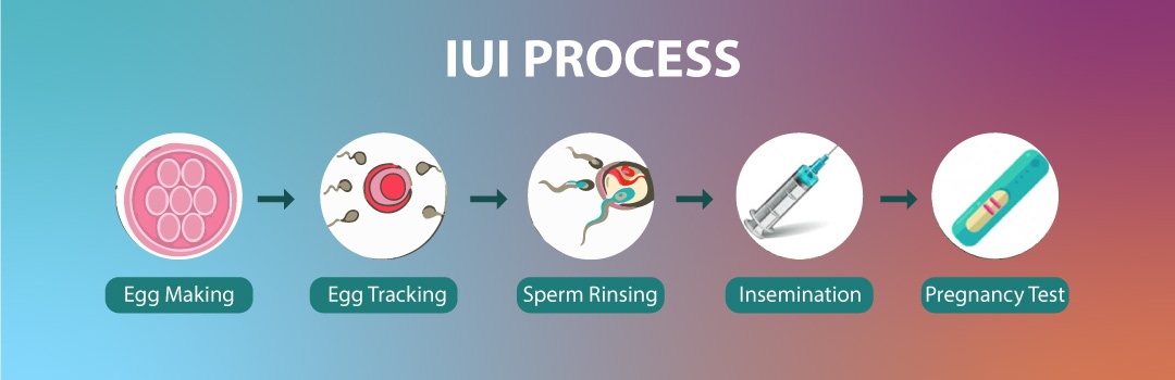 IUI Procedure step by step?