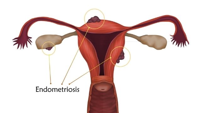 All About Endometriosis Treatment