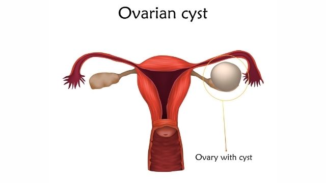 Ovarian Cyst Removal