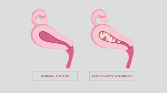 Ovarian Cyst Removal