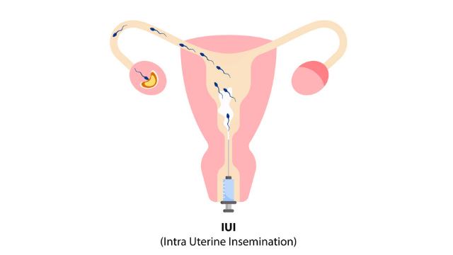 Ivf Iui