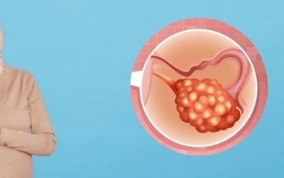 How To Get Pregnant With Ovarian Cyst?