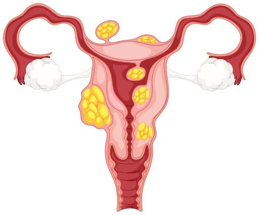 endometrial-carcinoma